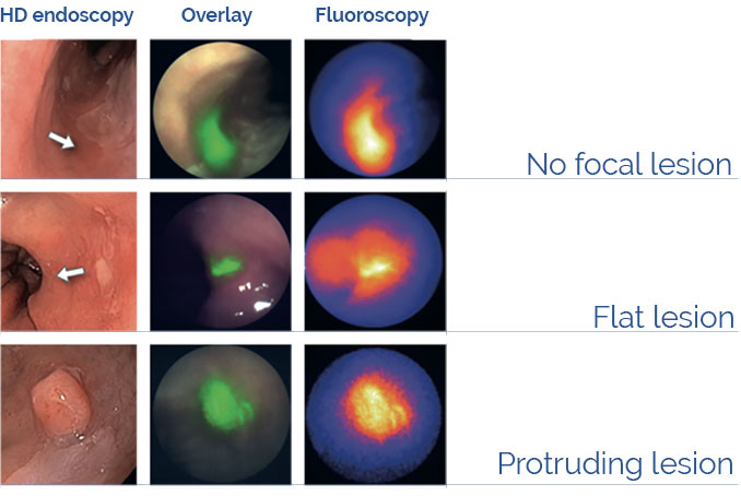 Fluorescence Guided Interventional Oncology